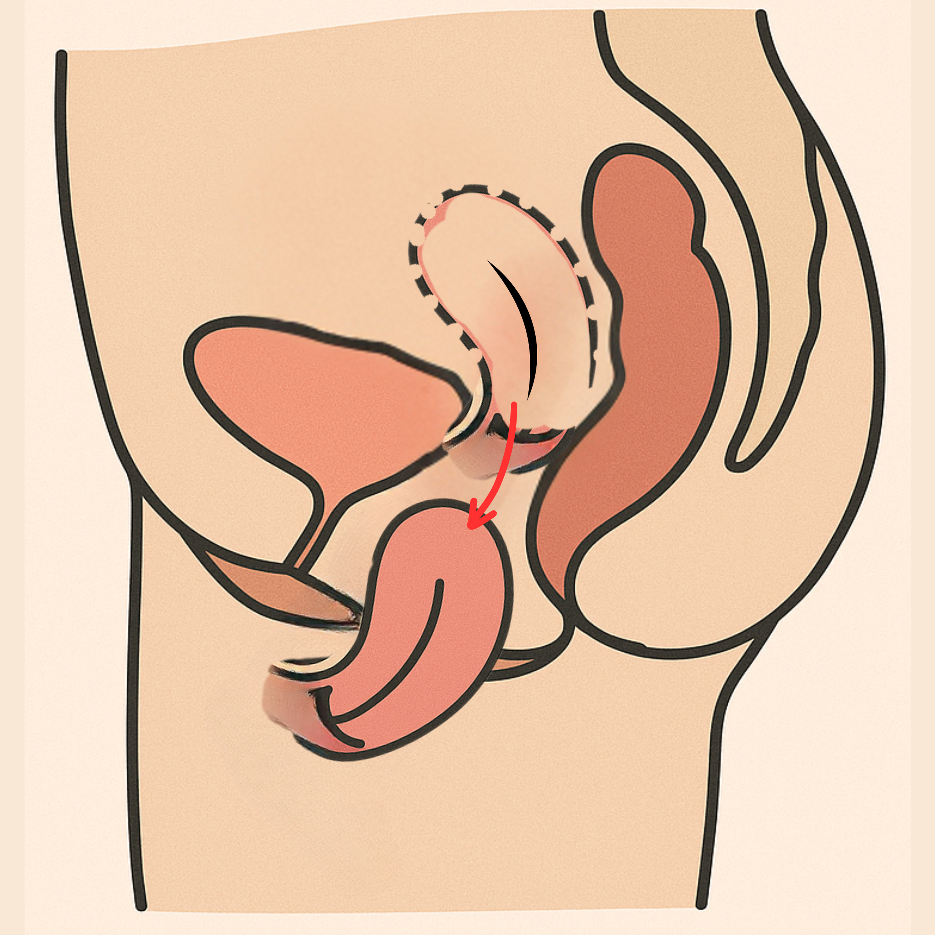 Uterine Prolapse